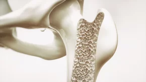 Contaminación: el nuevo origen de la osteoporosis